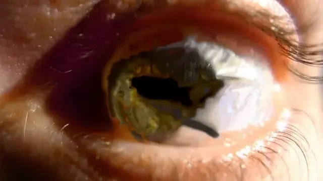 Acidic iris