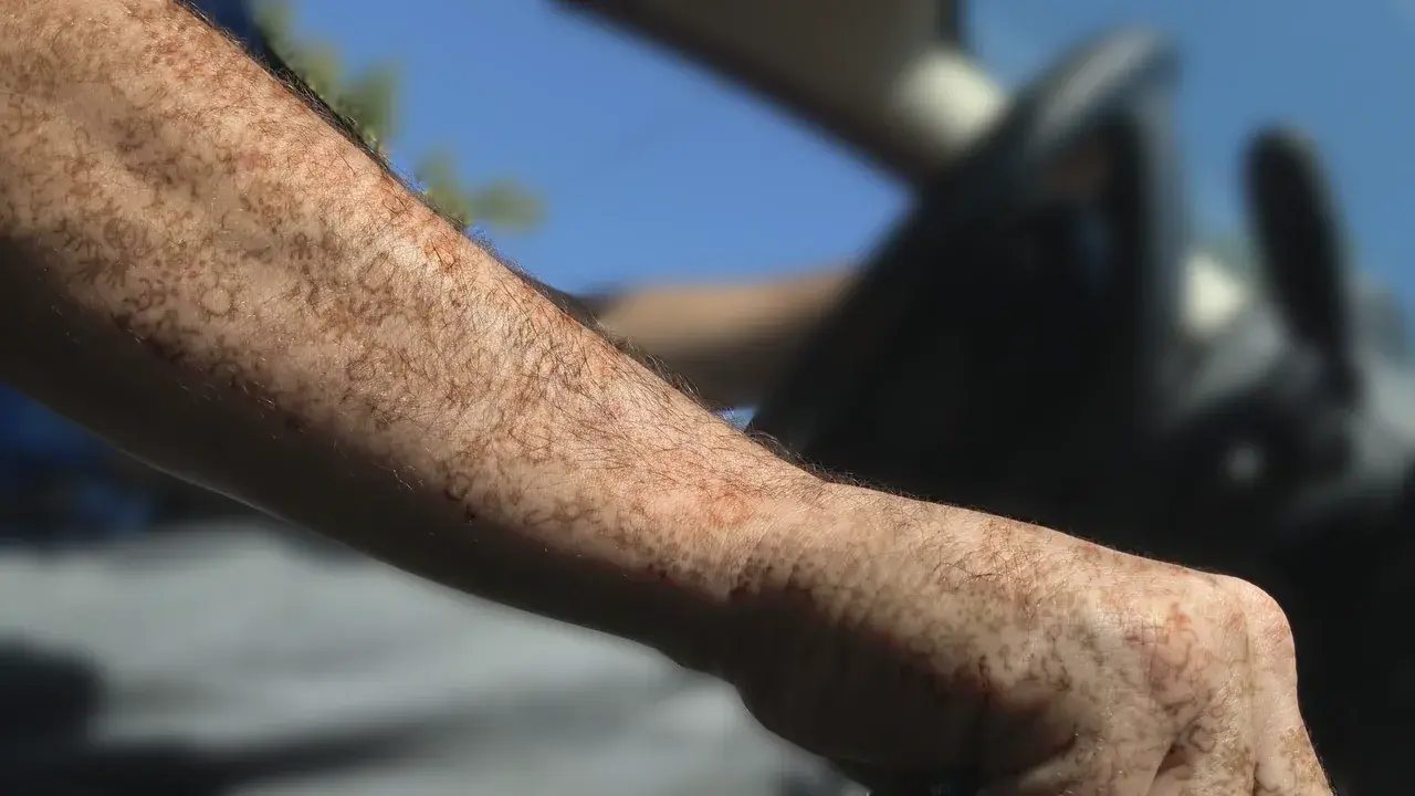 Watching your friend's arm (Patterning)
